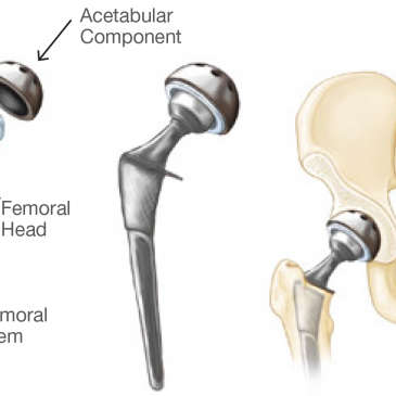 What Are The Risks Of Hip Surgery?